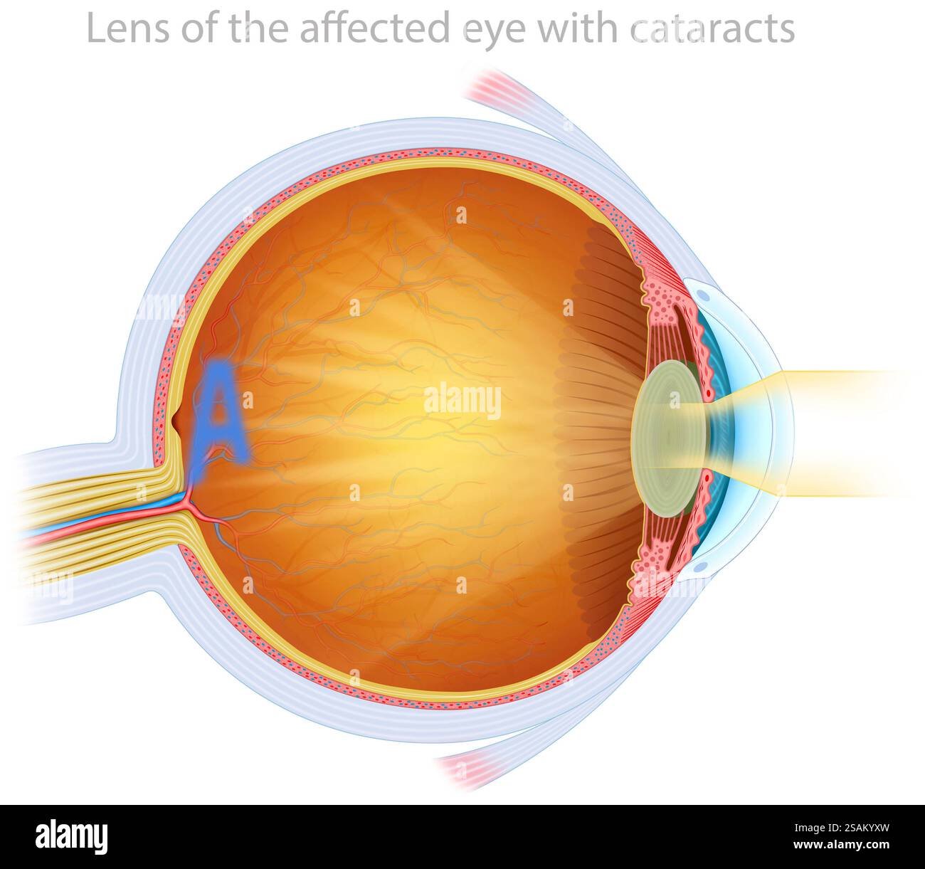 Illustration de la cataracte oculaire, qui est l'opacification progressive du cristallin, provoquant une vision floue et une diminution de l'acuité visuelle. Banque D'Images