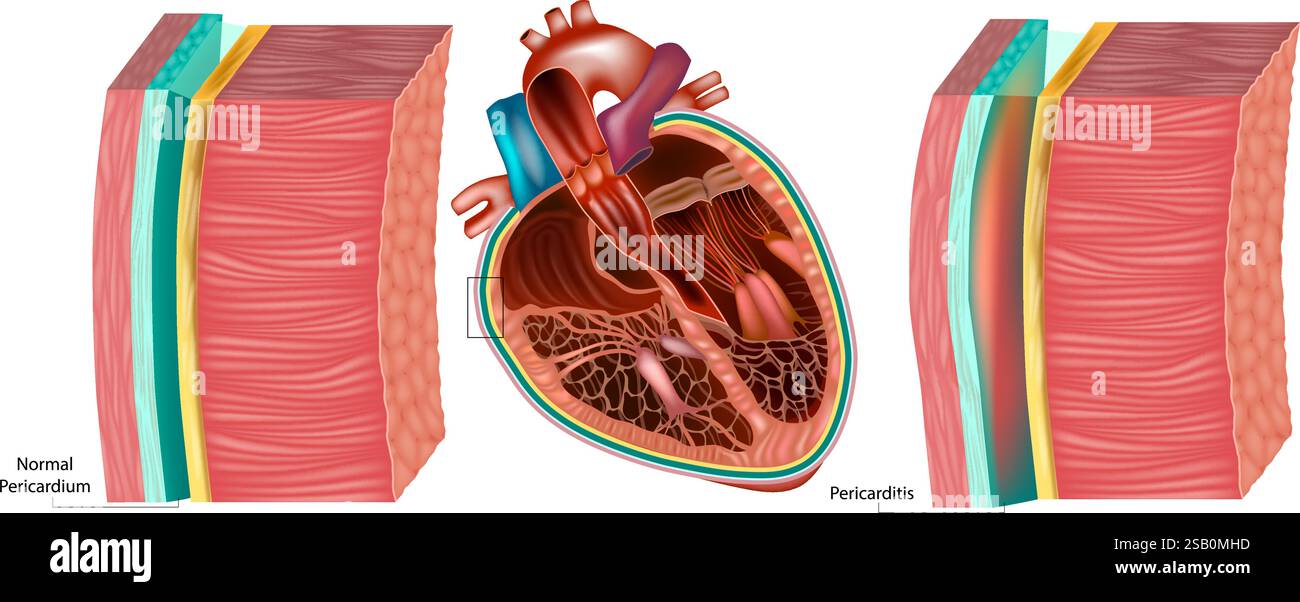Péricardite et péricarde normal illustration médicale. Coupe transversale du coeur avec péricardite. Inflammation cardiaque Illustration de Vecteur
