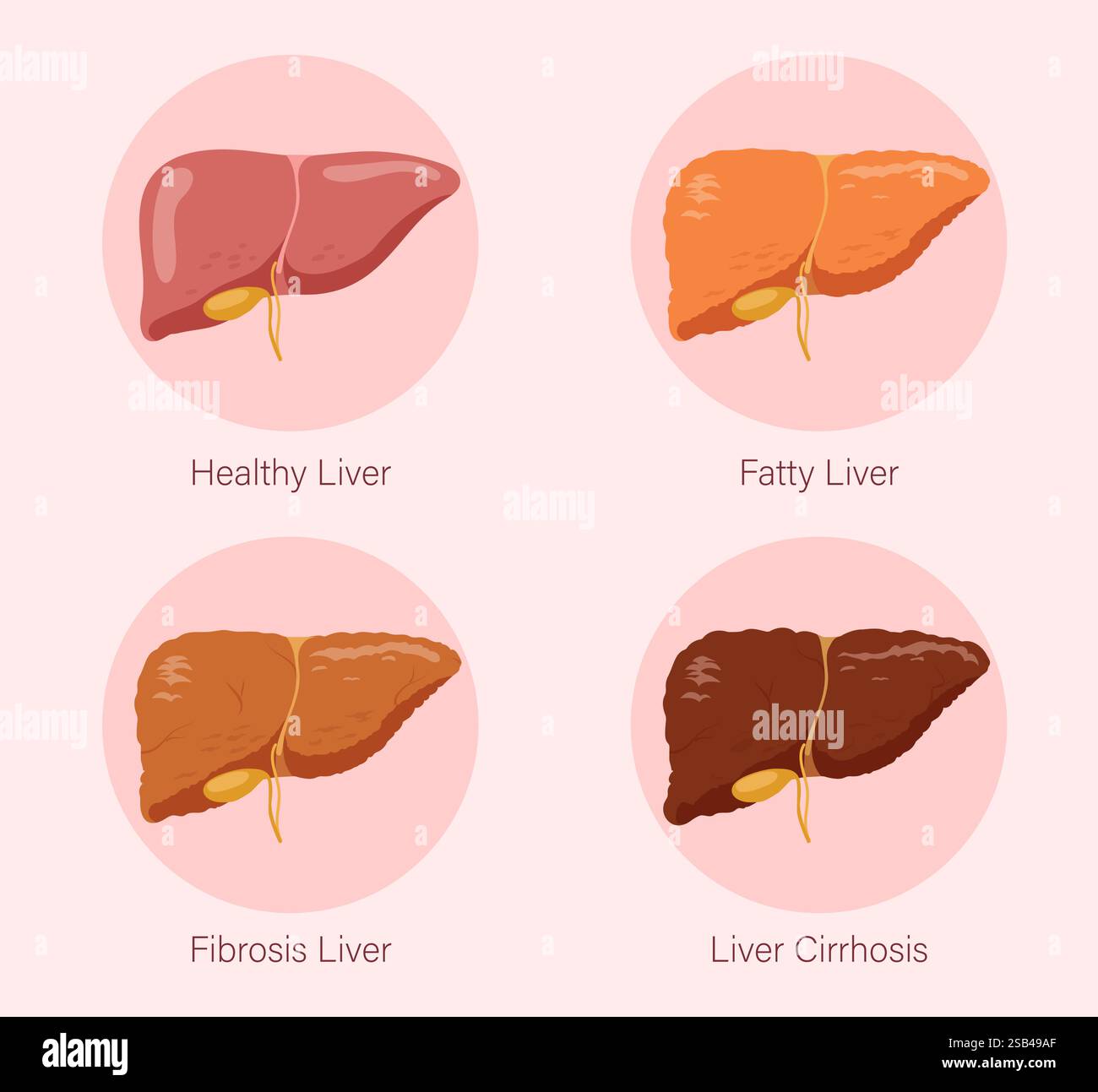 Illustration des stades de santé du foie. Illustration vectorielle Illustration de Vecteur