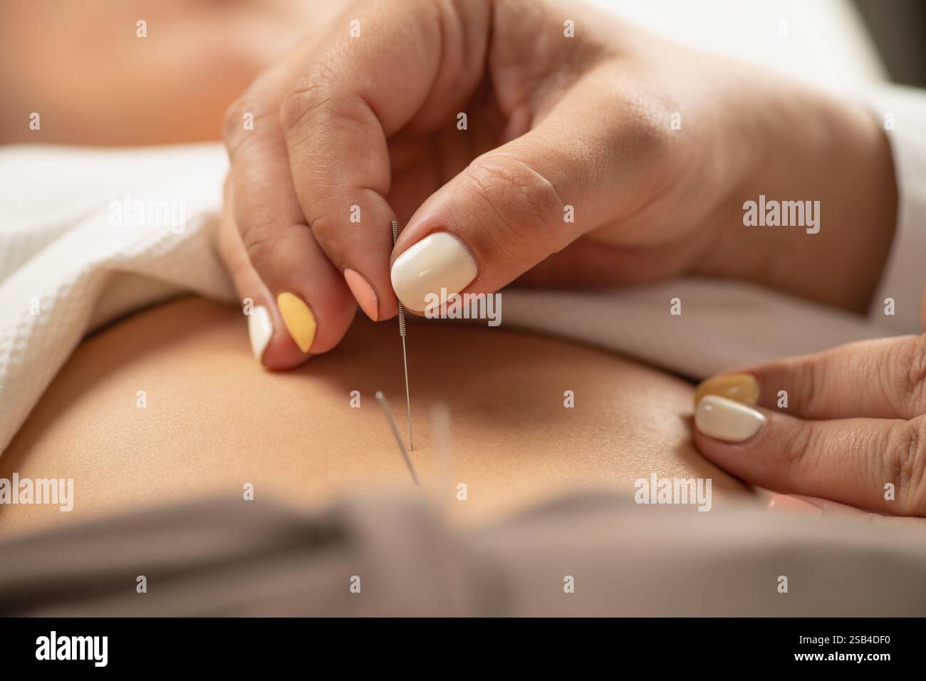 Acupuncteur stimulant les points d’acupuncture gastrique pour traiter l’œdème (rétention hydrique). Banque D'Images