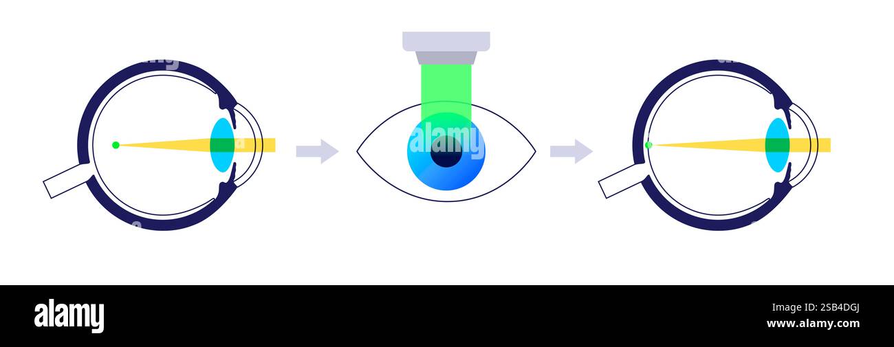 Illustration de LASIK (laser-Assisted in situ Keratomileusis) également connu sous le nom de chirurgie oculaire au laser. Il s'agit d'une intervention chirurgicale avancée conçue pour corriger les problèmes de vision courants, y compris la myopie, la myopie et l'astigmatisme. La procédure consiste à utiliser un laser précis pour remodeler la cornée, la partie avant transparente de l’œil, permettant à la lumière de se concentrer plus précisément sur la rétine. C'est un processus rapide, sûr et indolore. Banque D'Images