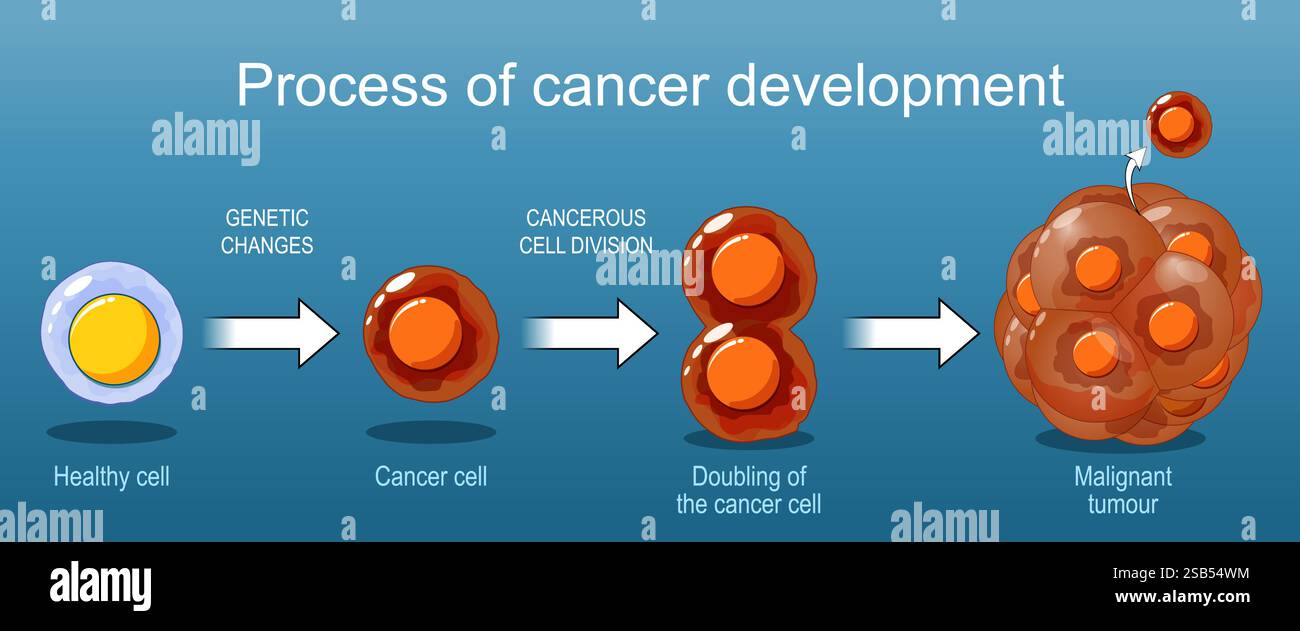 Processus de DEVELOPPEMENT du cancer D'une cellule saine a une tumeur maligne. Carcinogenèse. Mutations génétiques. Mutagenèse, oncogenèse, tumorigenèse. Tumeur Illustration de Vecteur