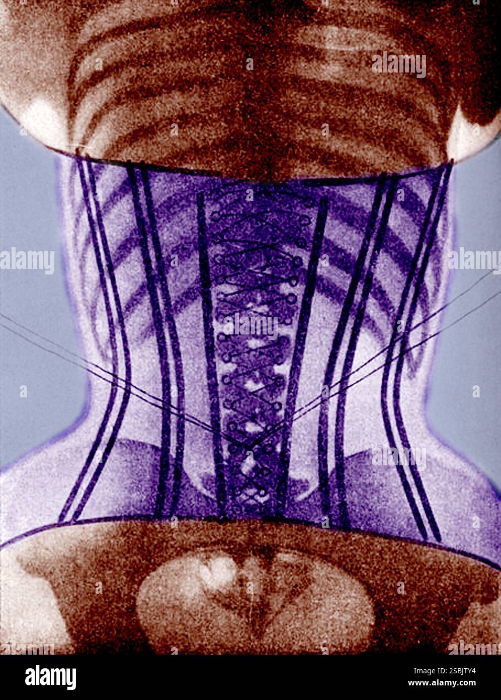 Image radiographique (vue arrière) d'une femme portant un corset tirée du deuxième volume du corset du Docteur français Ludovic O'Followell (1908). Bien que le Dr O'Followell ait clairement tenu à montrer l'impact néfaste des corsets sur la santé des femmes, il ne voulait pas vraiment que le corset soit aboli, mais essayait simplement d'encourager une conception moins sévère. Le Dr O'Followell a en fait continué à écrire une chronique régulière pour le magazine du corsetier de luxe les dessous Elegance. Banque D'Images