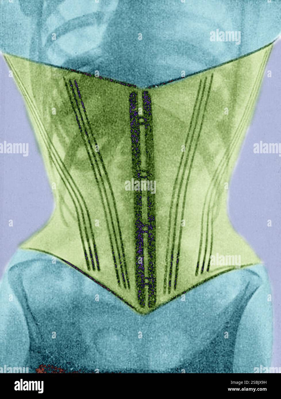 Radiographie (vue de face) d'une femme portant un corset du docteur Ludovic O'Followell le Corset (1908). Bien que le Dr O'Followell ait hâte de montrer l'impact néfaste des corsets sur la santé des femmes, il ne voulait pas que le corset soit aboli mais espérait plutôt encourager une conception moins sévère. Le Dr O'Followell a en fait continué à écrire une chronique régulière pour le magazine du corsetier de luxe les dessous Elegance. Banque D'Images