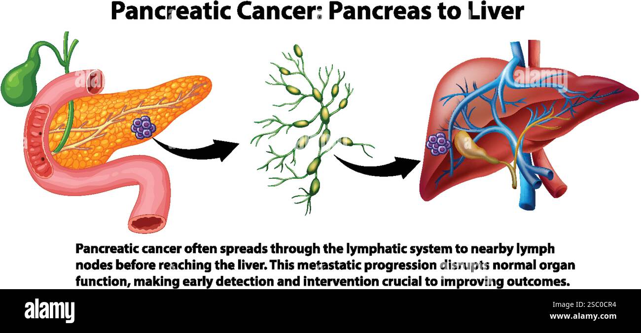 Illustration de la propagation du cancer du pancréas au foie Illustration de Vecteur