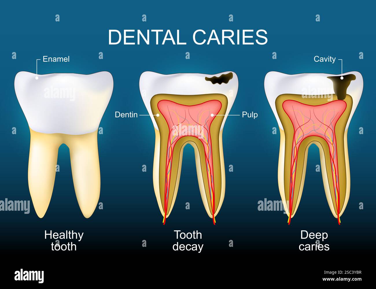 La carie dentaire. Dent saine, carie dentaire et caries profondes. Coupe transversale d'une dent humaine avec une couche d'émail au niveau de la couronne, de la cavité, de la pulpe et de la dentine. Illustration de Vecteur