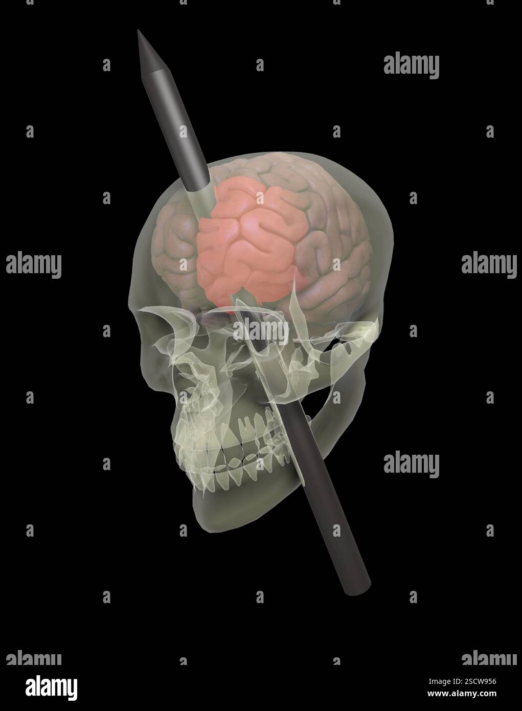 Phineas Gage (juillet 1823-mai 1860) était un ouvrier ferroviaire américain connu pour avoir survécu à une lésion cérébrale traumatique causée par une tige de fer qui lui a tiré à travers le crâne et détruit la majeure partie du lobe frontal gauche de son cerveau. La blessure aurait causé des changements majeurs à sa personnalité, ce qui en ferait un cas marquant en neurosciences. Banque D'Images