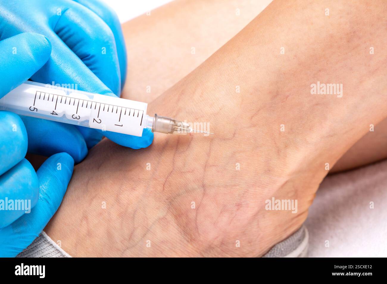 Ablation des varices sur les jambes. Inspection médicale et traitement des télangiectasies. Phlébeurysme. Banque D'Images