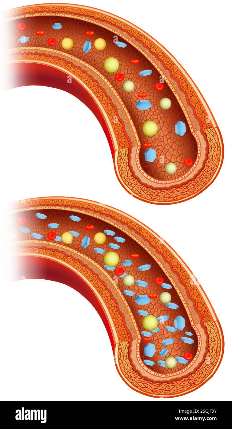 Schéma artériel, où dans l'un il y a hyperglycémie due à l'augmentation anormale de la glycémie, causée par le diabète, l'autre est normal. Banque D'Images