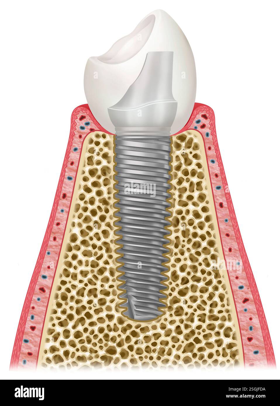 Illustration schématique de l’intérieur d’une dent, où l’on peut voir un implant dentaire et les différents éléments qui le composent. Banque D'Images