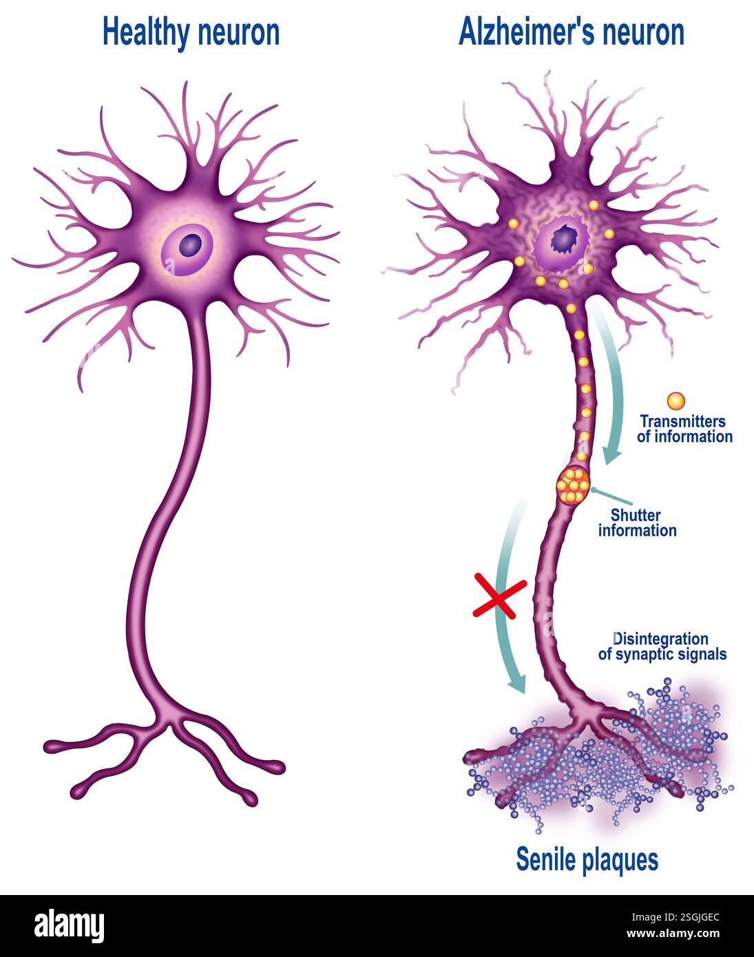 Illustration schématique du neurone affecté dans la maladie d'Alzheimer. Trouble neurodégénératif progressif qui cause une perte de mémoire. Banque D'Images