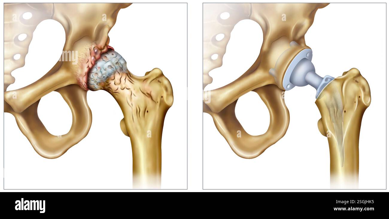 Schéma de l'arthrose, une maladie dégénérative qui affecte les articulations, causant douleur, raideur et usure du cartilage. Banque D'Images