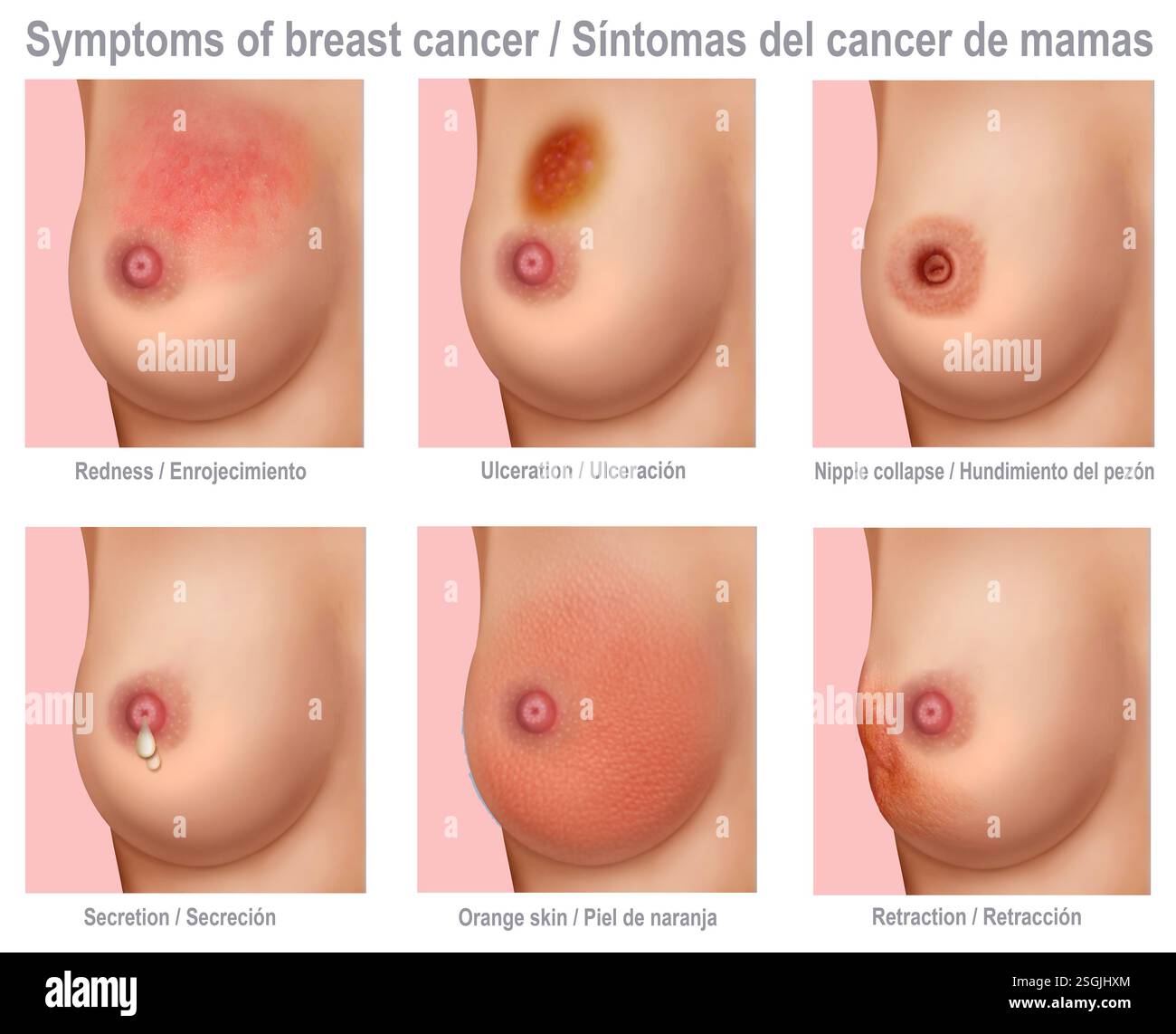 Illustration des différents états et caractéristiques d'une femme atteinte d'un cancer du sein. Banque D'Images