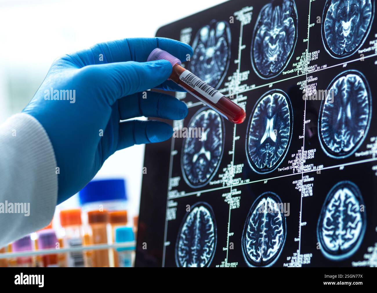 Recherche en neurologie, échantillon de sang de patients vérifié par rapport au scan médical pendant un essai clinique Banque D'Images