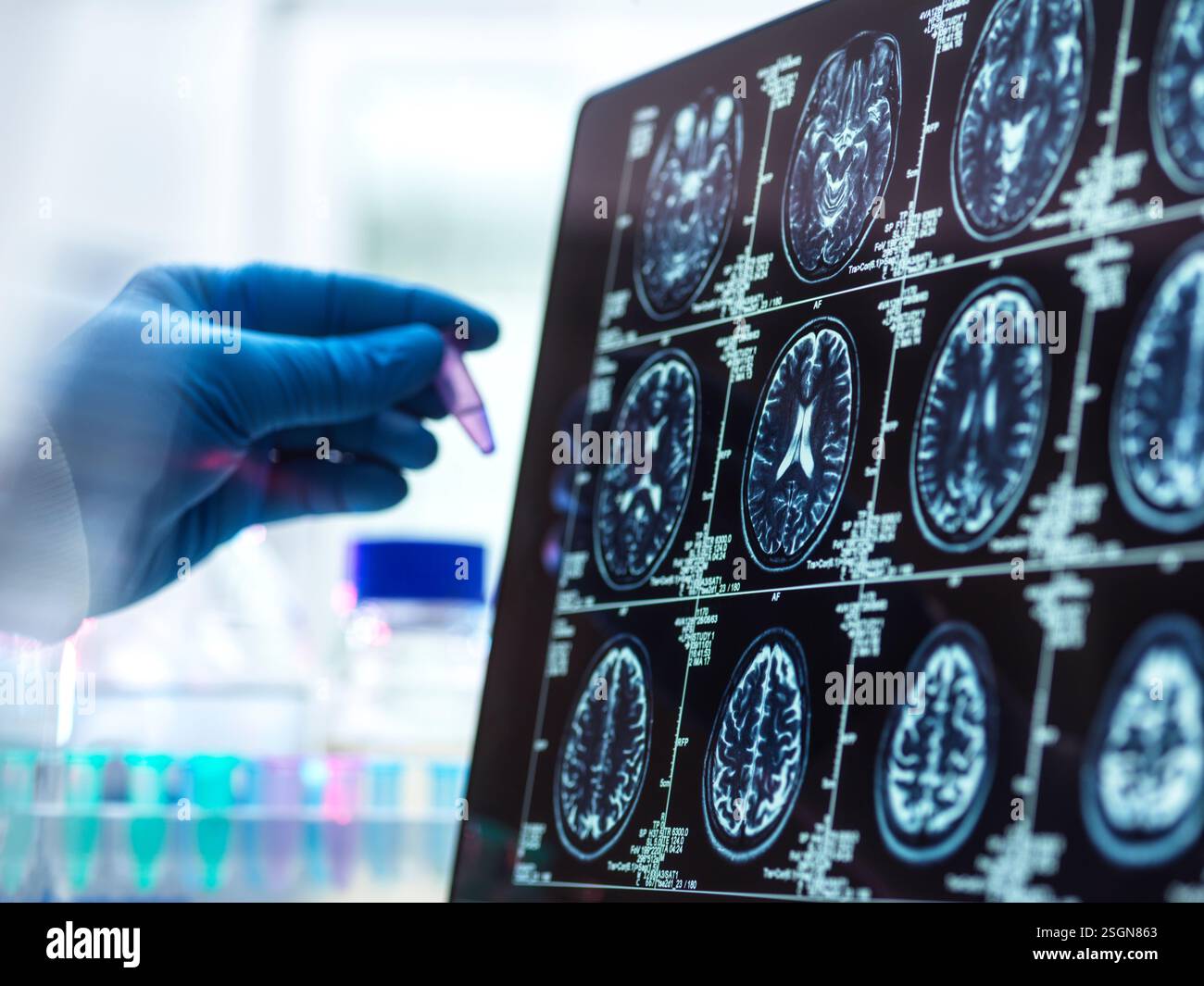 La démence et la recherche d'Alzhiemer, scientifique préparant un échantillon humain au cours d'un essai clinique Banque D'Images