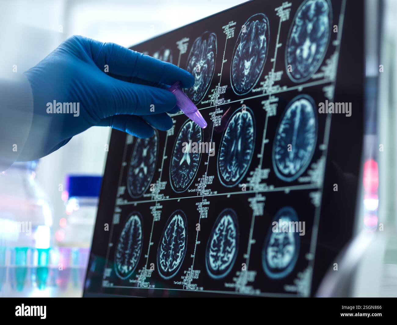 La démence et la recherche d'Alzhiemer, scientifique préparant un échantillon humain au cours d'un essai clinique Banque D'Images