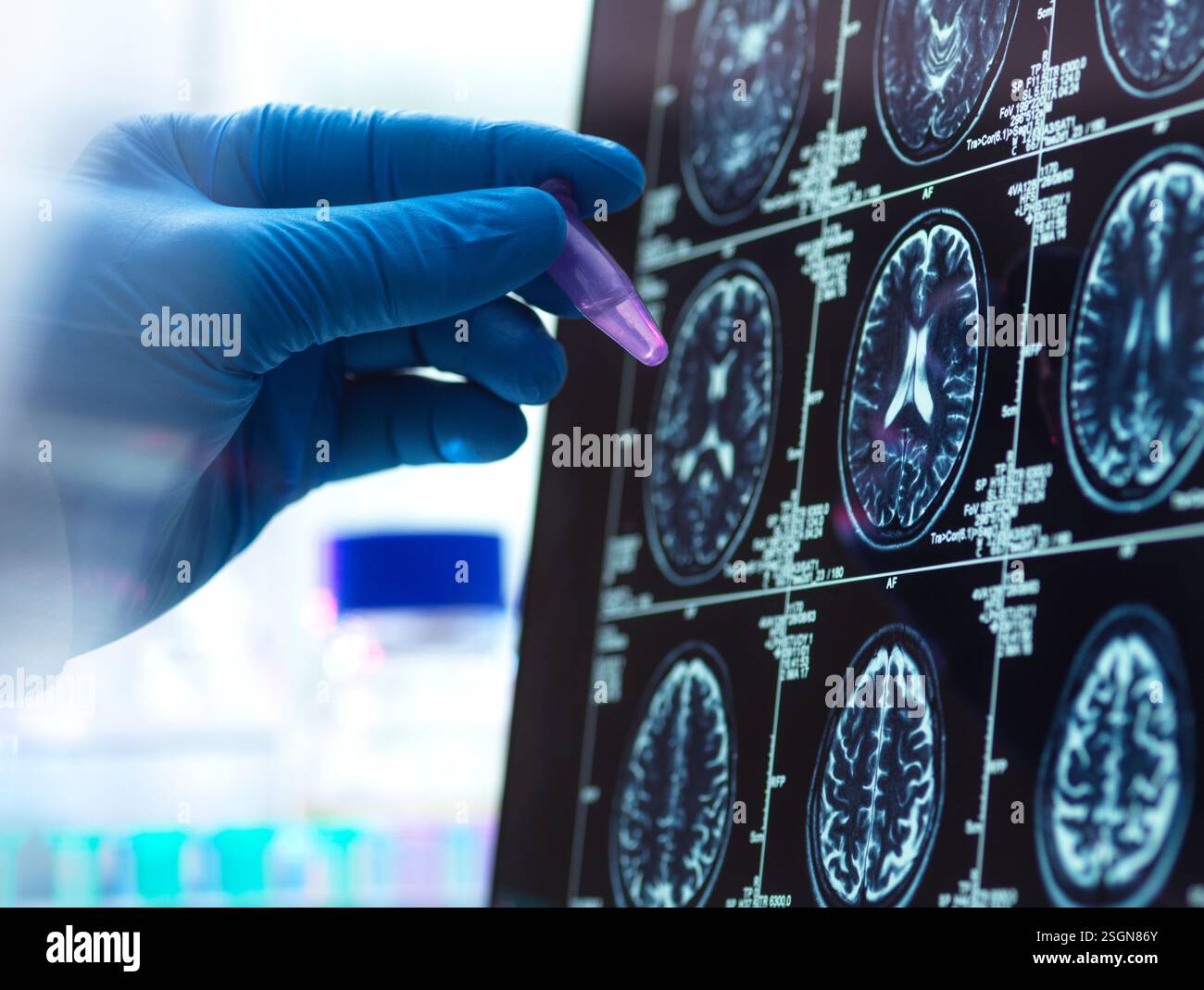 La démence et la recherche d'Alzhiemer, scientifique préparant un échantillon humain au cours d'un essai clinique Banque D'Images