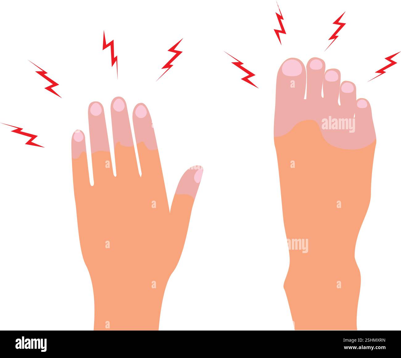 Froid et engourdissement au bout des doigts. Illustration vectorielle des pieds et des mains. Illustration de Vecteur Froid et engourdissement au bout des doigts. Illustration vectorielle des pieds et des mains. Illustration de Vecteur