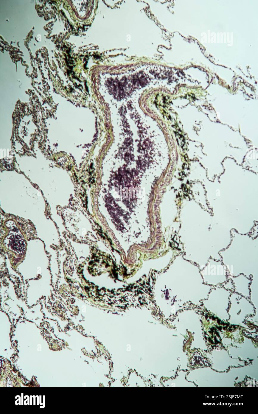 Tissu pulmonaire asthmatique au microscope Banque D'Images