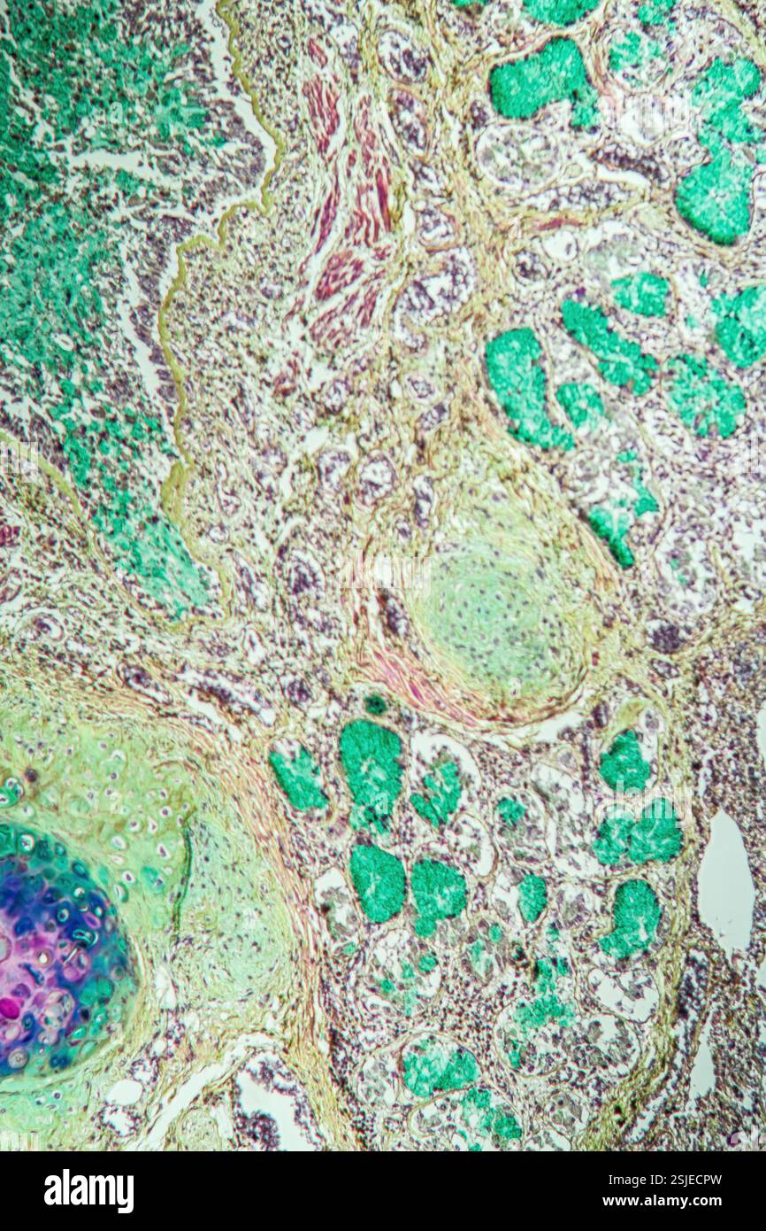 Tissu pulmonaire asthmatique au microscope Banque D'Images