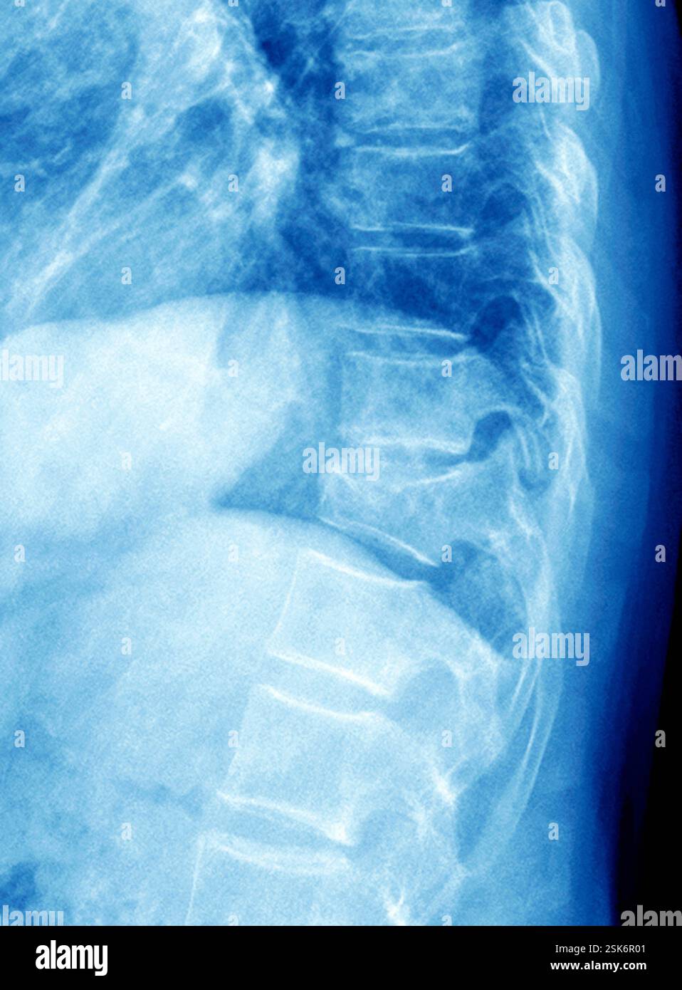 Ost oporose Du Rachis Radiographie D une Section Du Rachis Thoraco 
