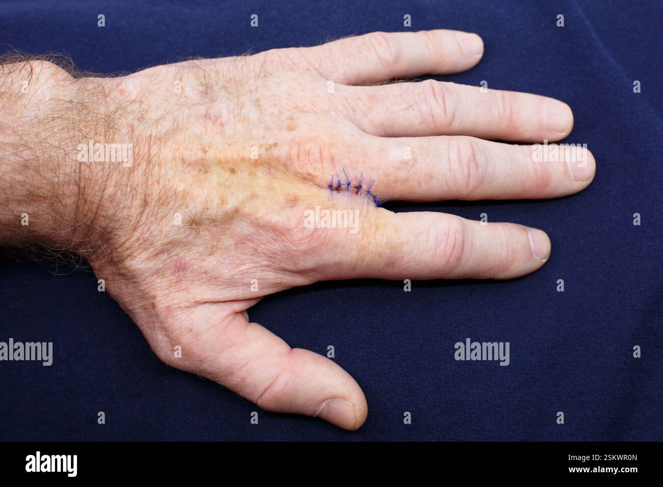 Main d'un homme d'âge moyen montrant des ecchymoses et des points de suture de la chirurgie de Moh pour éliminer le carcinome épidermoïde cancer de la peau dû à l'exposition au soleil. Banque D'Images