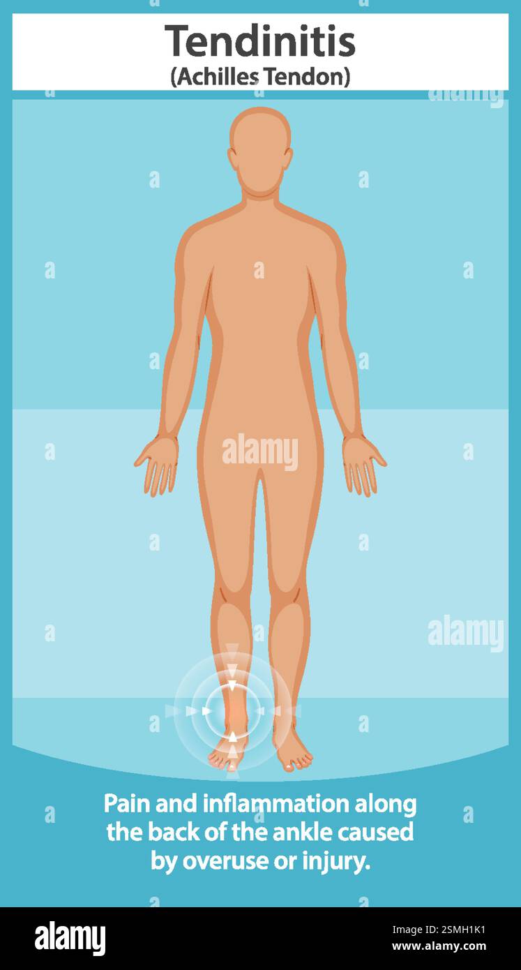Représente la douleur et l'inflammation du tendon d'Achille Illustration de Vecteur
