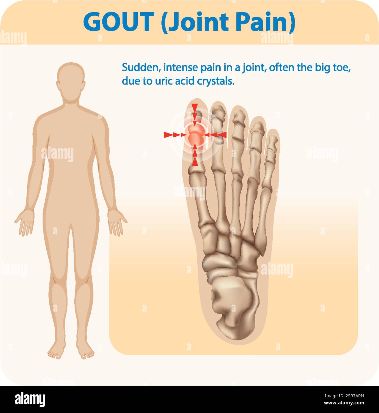 Illustration de la goutte affectant l'articulation du gros orteil Illustration de Vecteur