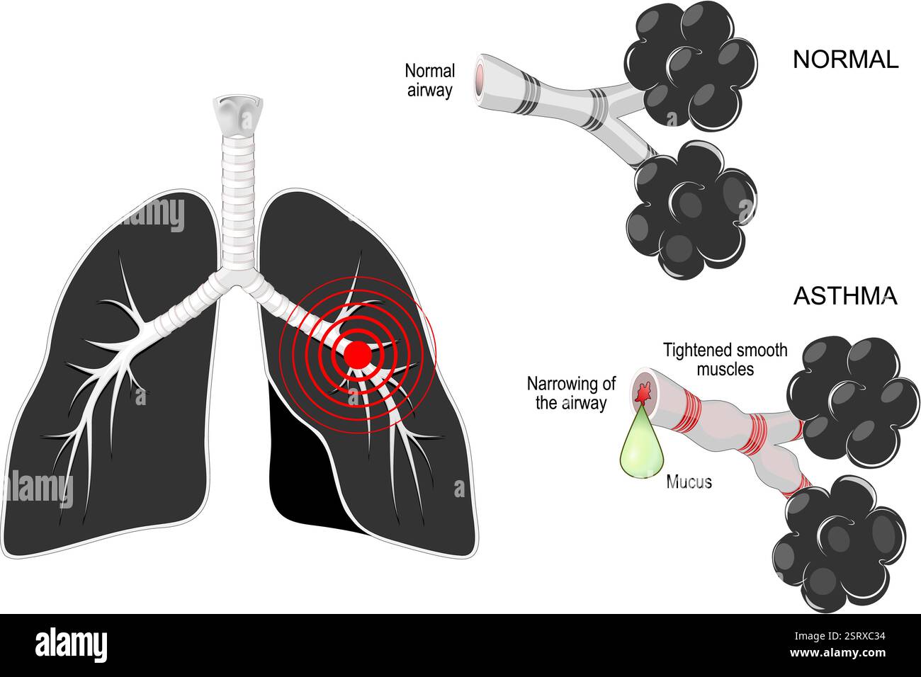 Asthme. Maladies respiratoires. Poumons noirs avec marque rouge, et bronches sur fond blanc. Gros plan des voies aériennes normales et bronchoconstriction avec Narro Illustration de Vecteur