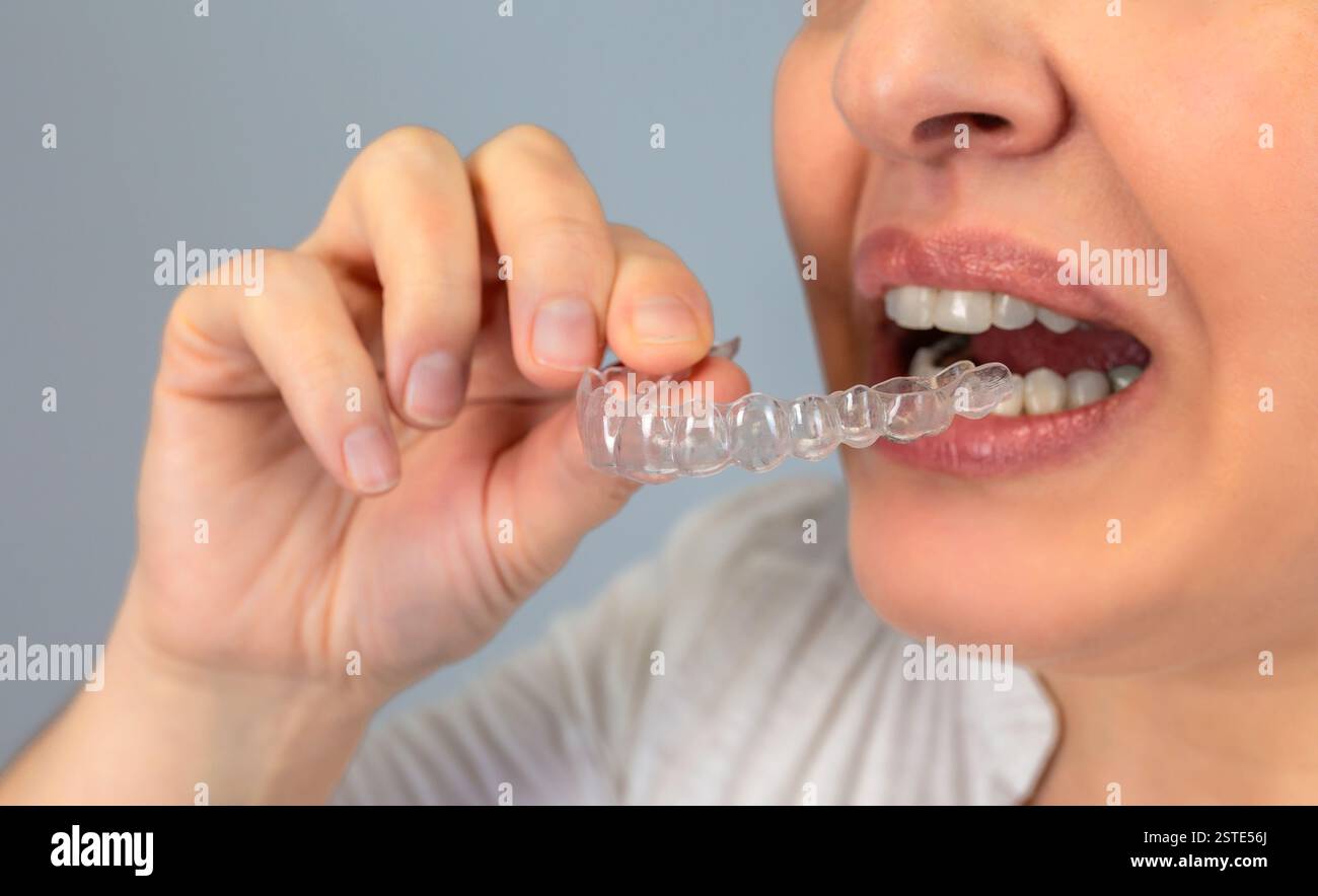 Image anonyme en gros plan d'une personne insérant un aligneur dentaire transparent, mettant en évidence le traitement orthodontique moderne Banque D'Images
