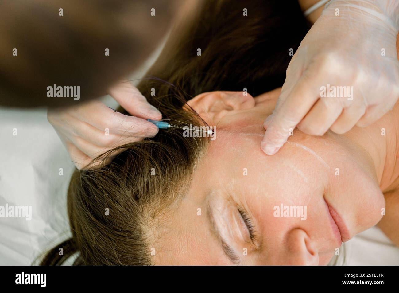 Gros plan d'un professionnel effectuant une procédure de lifting du fil sur le front d'une femme dans une clinique esthétique, indiquant un traitement de rajeunissement facial Banque D'Images
