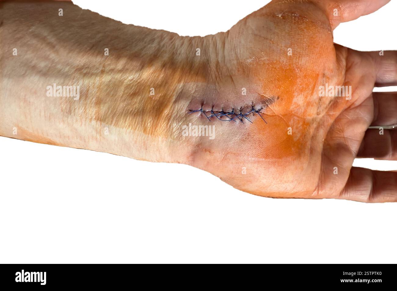 Bandage pour chirurgie corporelle de suture de plaie Banque D'Images