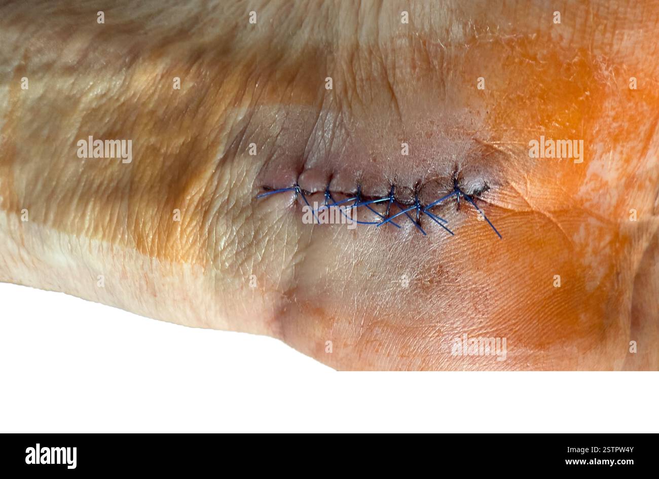 Bandage pour chirurgie corporelle de suture de plaie Banque D'Images