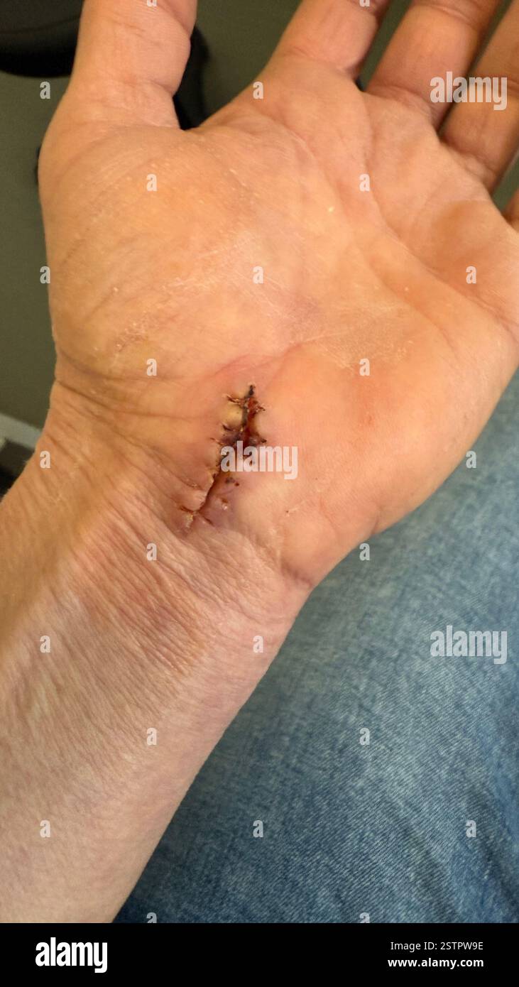 Bandage pour chirurgie corporelle de suture de plaie Banque D'Images