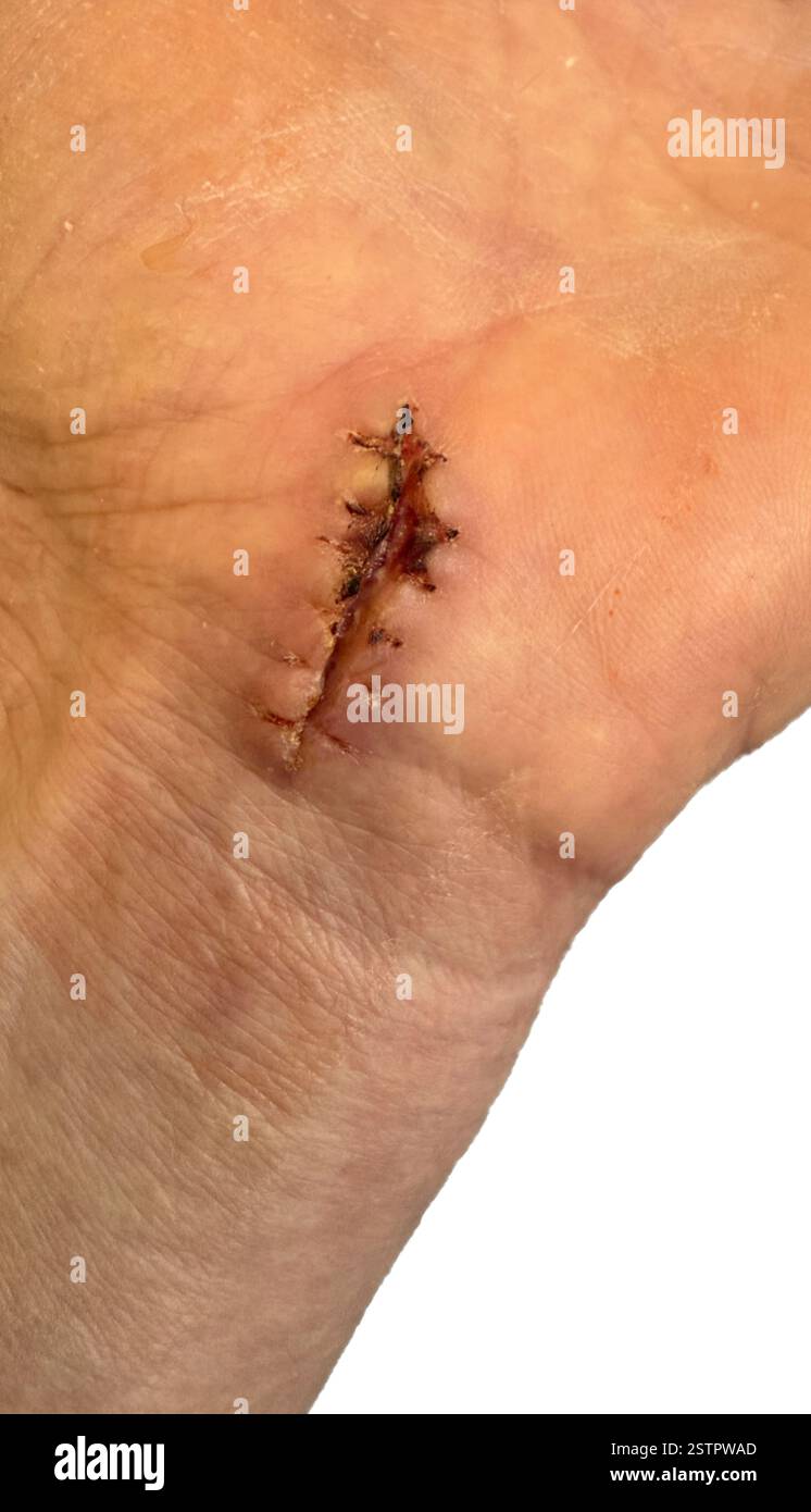 Bandage pour chirurgie corporelle de suture de plaie Banque D'Images