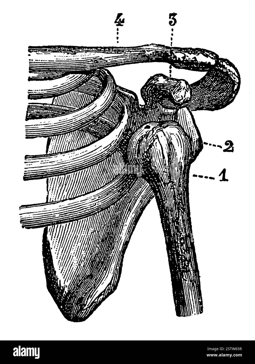 Luxation de l'épaule. Illustration du 19e siècle. Allemagne. Arrière-plan blanc. Banque D'Images