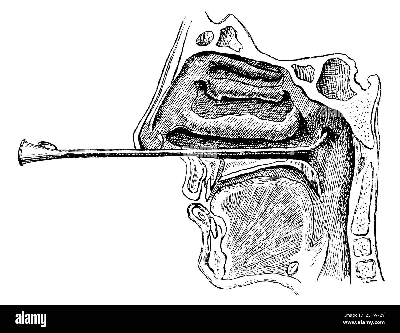 Ouverture de gorge de la trompette Eustache. Illustration du XIXe siècle. Allemagne. Banque D'Images
