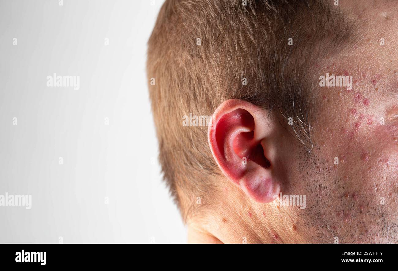 Rougeurs et taches rouges sur les oreilles et la tête d'un homme après avoir bu de l'alcool. Dermatite alcoolique et urticaire. Allergie à l'alcool, gros plan Banque D'Images