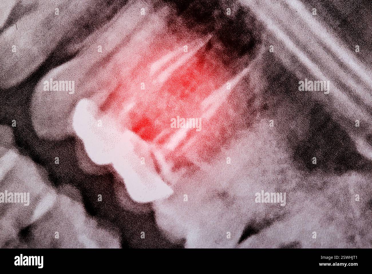 Canaux rouges enflammés des dents pulpeuses avec couronnes à la radiographie en odonto-stomatologie Banque D'Images