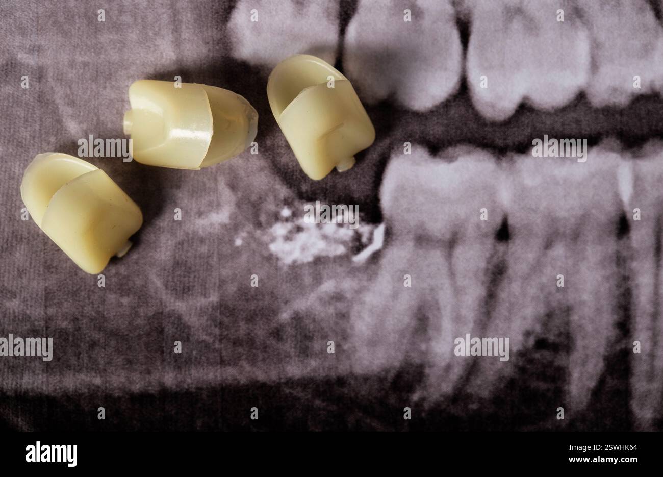 dents de sagesse artificielles sur fond d'image radiographique avec une dent de sagesse extraite Banque D'Images