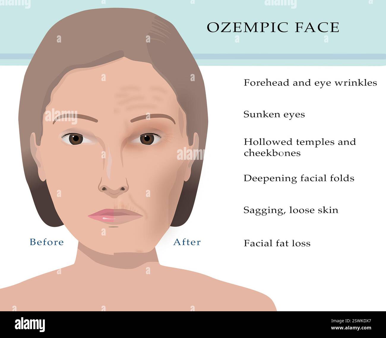 Les patients prenant Ozempic développent souvent ce qu'on appelle communément le « visage d'Ozempic ». Cette condition se produit avec d'autres médicaments de perte de poids aussi bien, tels que Wegovy (semaglutide), Mounjaro (tripeptide), et liraglutide (Saxenda). Elle peut inclure des rides du front et des yeux, des yeux enfoncés, des tempes et des pommettes creusées, des plis faciaux plus profonds et une peau relâchée et affaissée. Banque D'Images