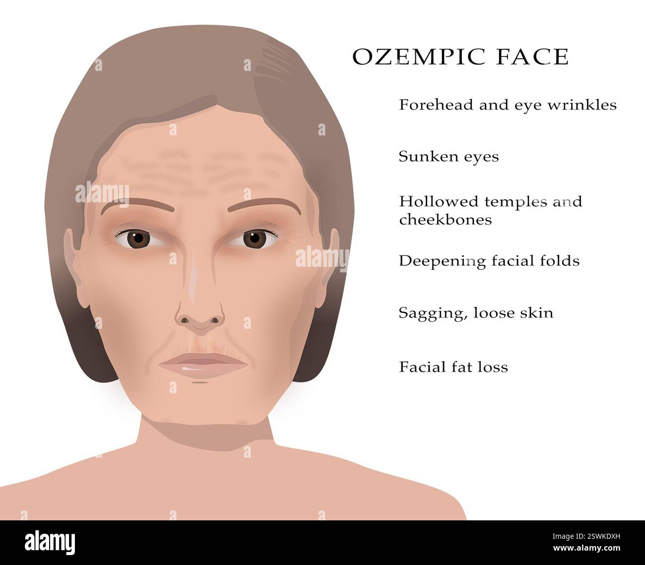 Les patients prenant Ozempic développent souvent ce qu'on appelle communément le « visage d'Ozempic ». Cette condition se produit avec d'autres médicaments de perte de poids aussi bien, tels que Wegovy (semaglutide), Mounjaro (tripeptide), et liraglutide (Saxenda). Elle peut inclure des rides du front et des yeux, des yeux enfoncés, des tempes et des pommettes creusées, des plis faciaux plus profonds et une peau relâchée et affaissée. Banque D'Images