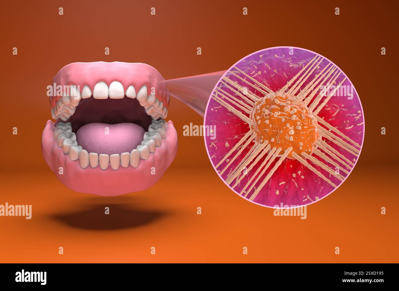 Cancer de la bouche (langue, cavité buccale) - vue isométrique 3d illustration Banque D'Images