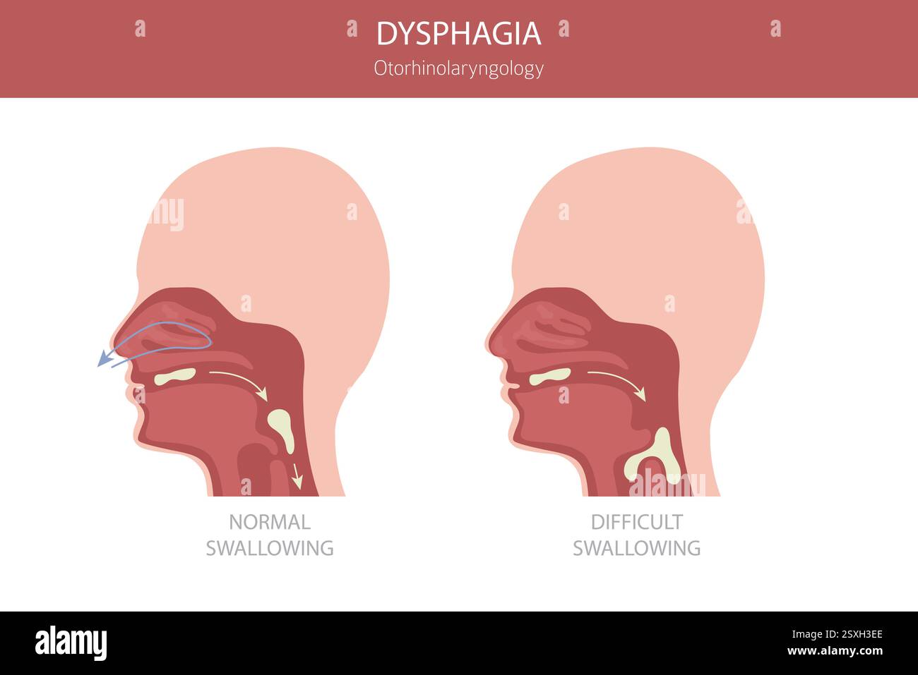 Dysphagies buccales. Oto-rhino-laryngologie. Déglutition difficile. Conception infographique médicale. Illustration vectorielle Illustration de Vecteur