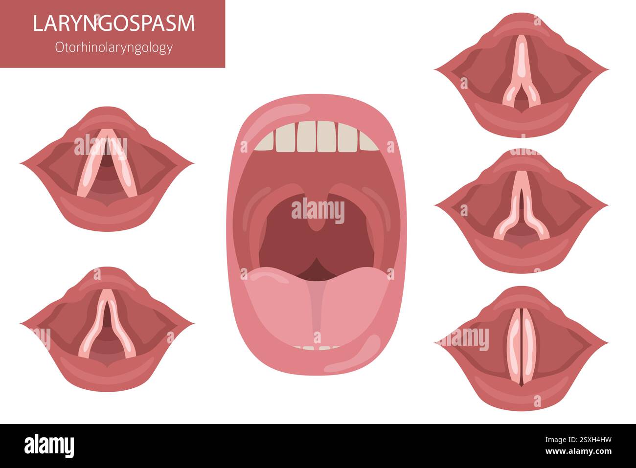 Maladies du laryngospasme. Oto-rhino-laryngologie. Dysfonctionnement ...