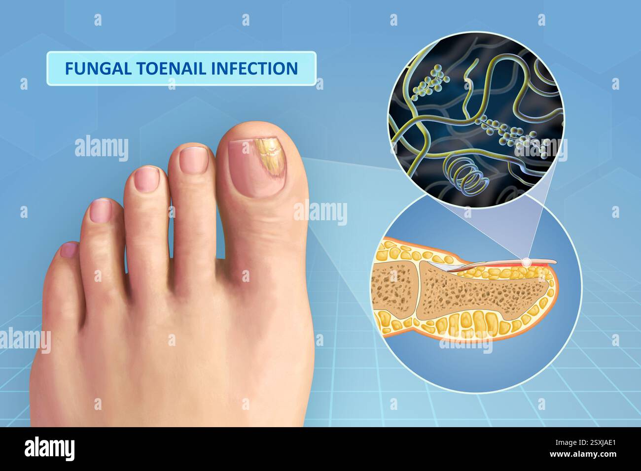 Diagramme montrant les pathogènes fongiques dans un ongle d'orteil. Illustration numérique. Banque D'Images