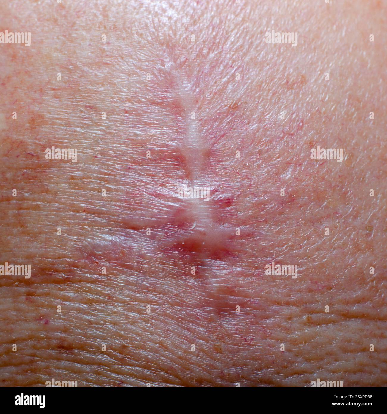 Cicatrice avec fils après ablation d'un cancer de la peau sur la tête Banque D'Images