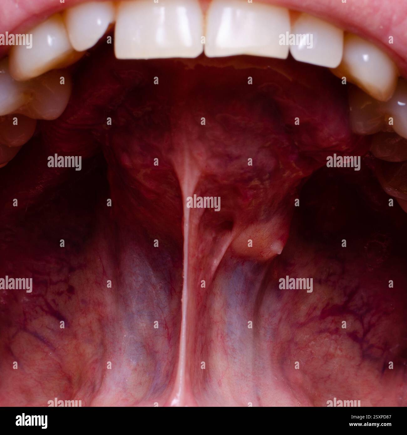 Tumeur de la cavité buccale d'un adulte, gros plan. problèmes dentaires. Banque D'Images