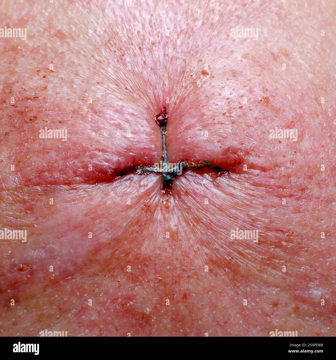 La plaie a été suturée avec des fils chirurgicaux. Ablation chirurgicale d'un basaliome sur la peau de la face. Banque D'Images