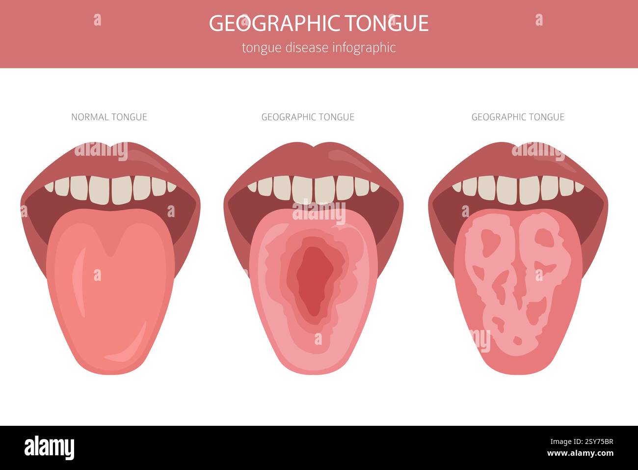Maladie linguistique géographique. Médecine buccale. Conception infographique médicale. Illustration vectorielle Illustration de Vecteur